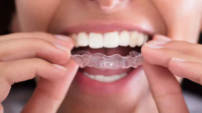 Инвизилайн (Invisalign)